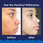 فوم شوینده ضد جوش پانوکسیل panoxyl حاوی بنزوئیل پراکسید 10%